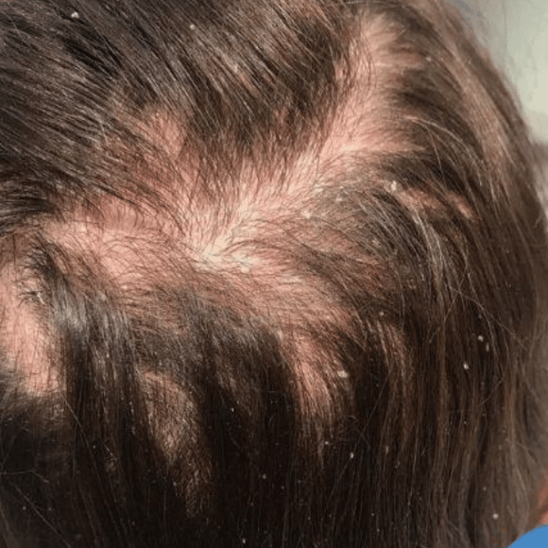 Seborrheea Seborrhea - Oxygeni Hair & Skin - Hajgyógyászati és kozmetikai ...