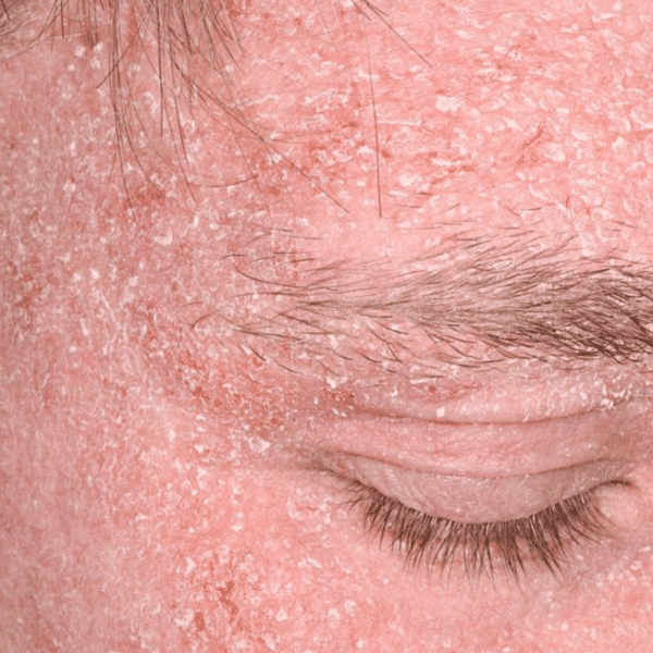 Seborrhea - Oxygeni Hair & Skin - Hajgyógyászati és kozmetikai ...