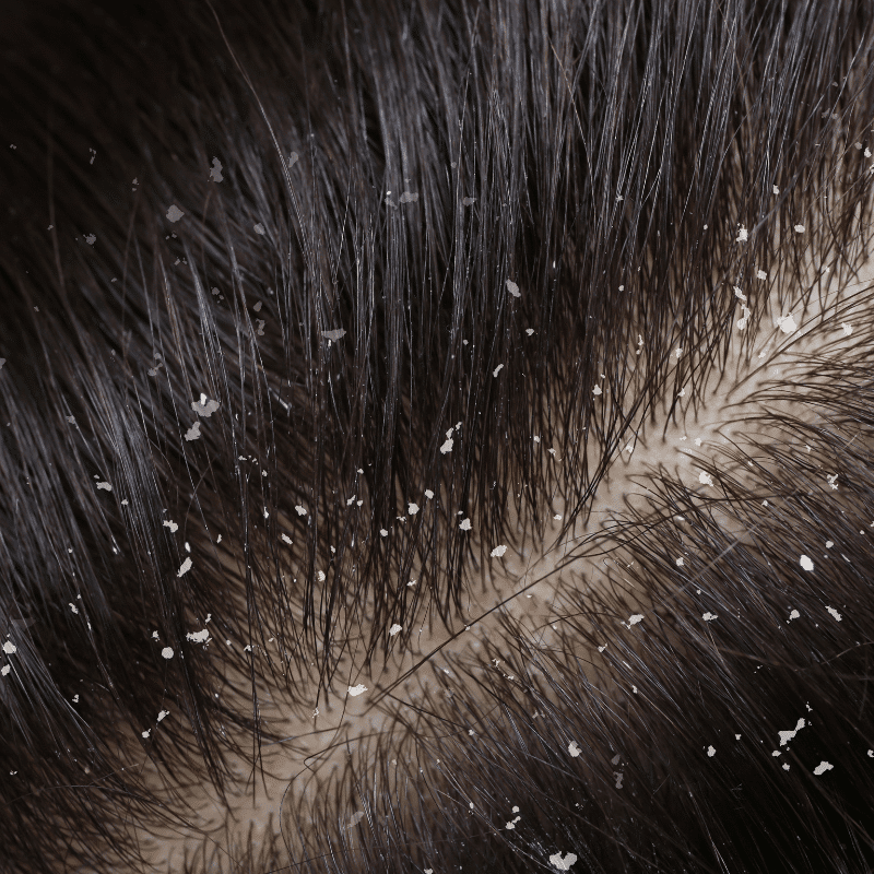 Seborrhea - Oxygeni Hair & Skin - Hajgyógyászati és kozmetikai ...