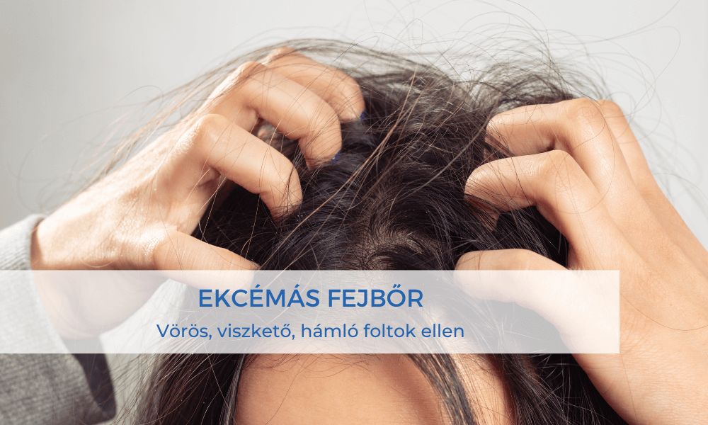 ekcémás fejbőr blog