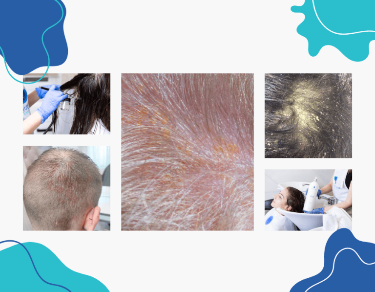 Seborrhea - Oxygeni Hair & Skin - Hajgyógyászati és kozmetikai ...
