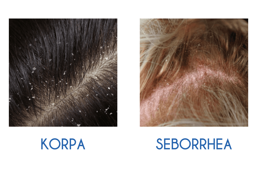 seborrhea