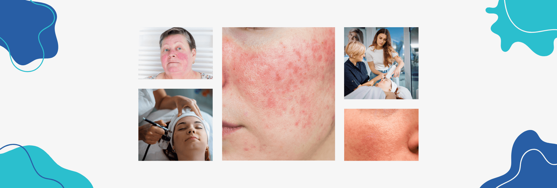 rosacea kezelése