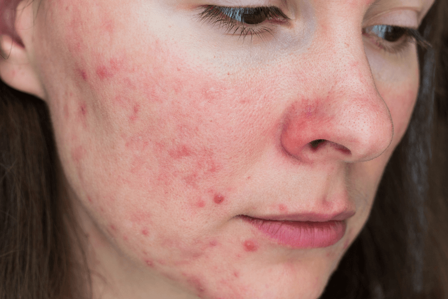 rosacea kezelése