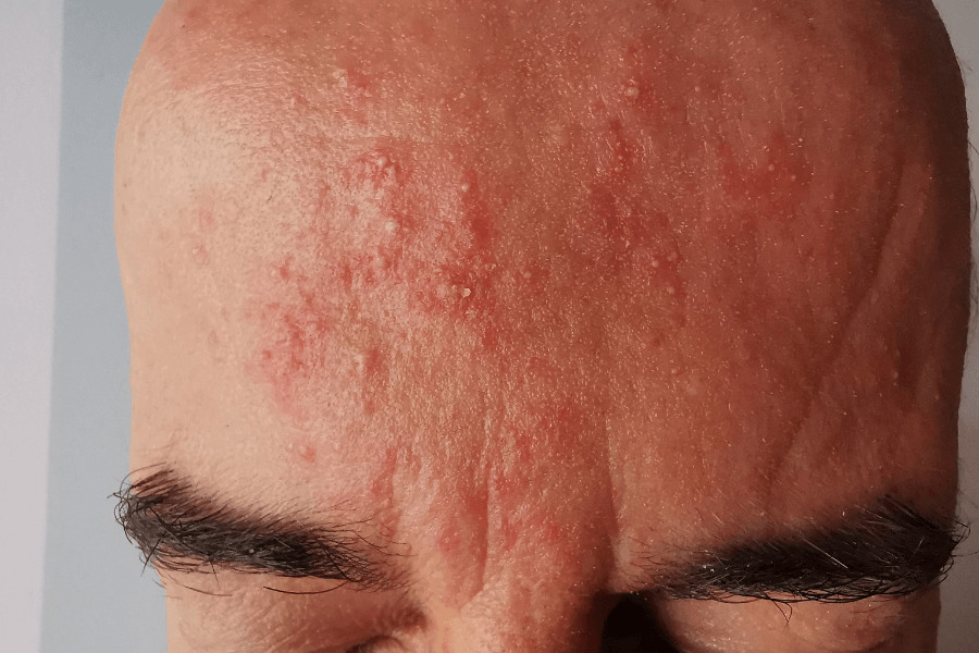 rosacea kezelése