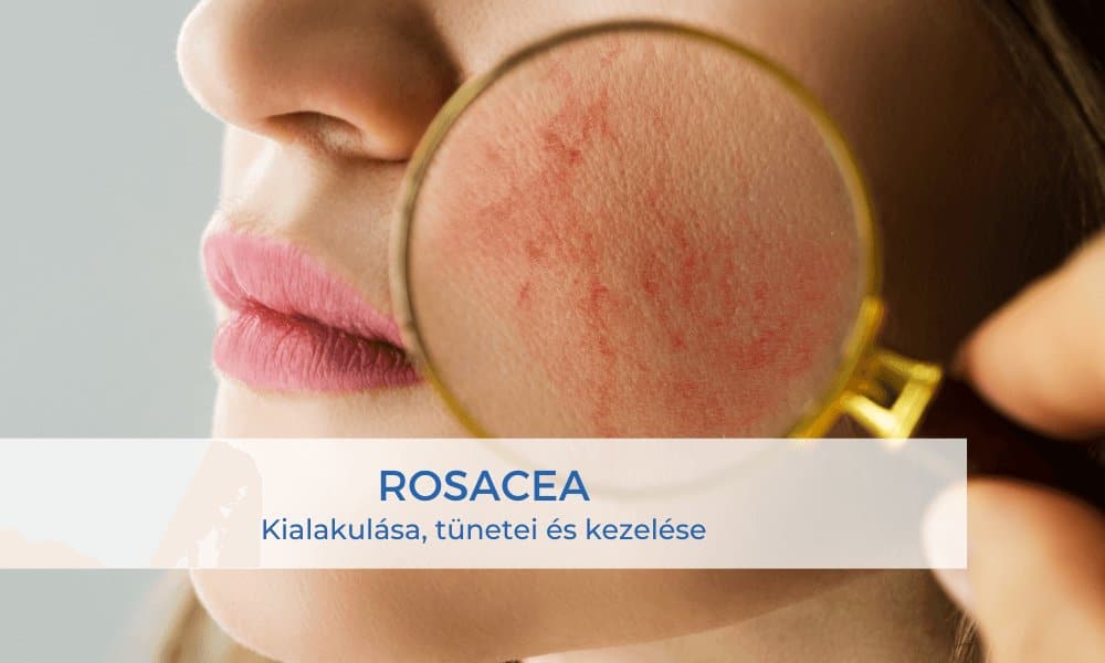 rosacea blog