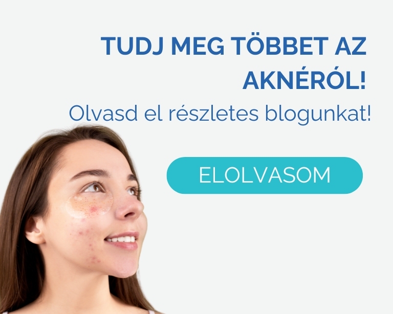 akne-kezelese