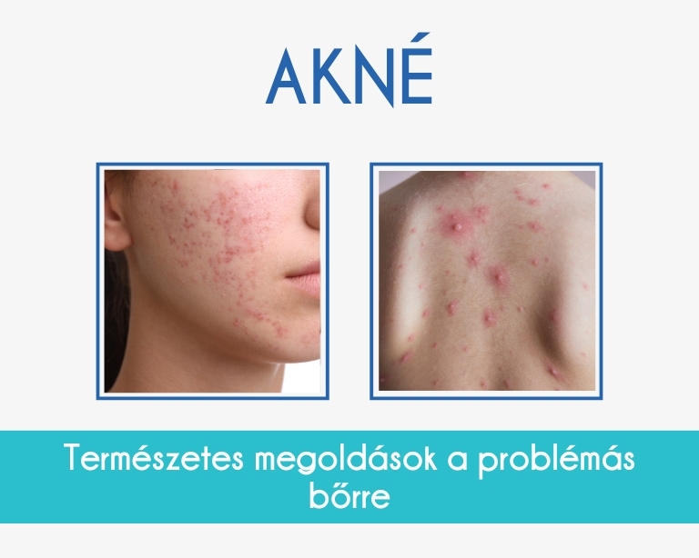 akne-kezelese