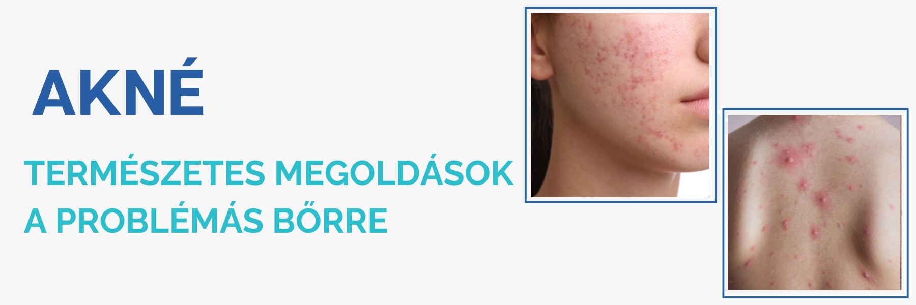 akne-kezelese
