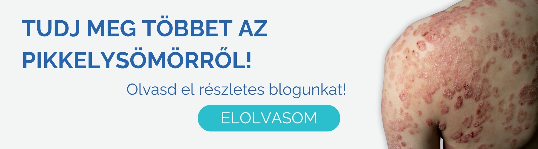 pikkelysomor_kezelese