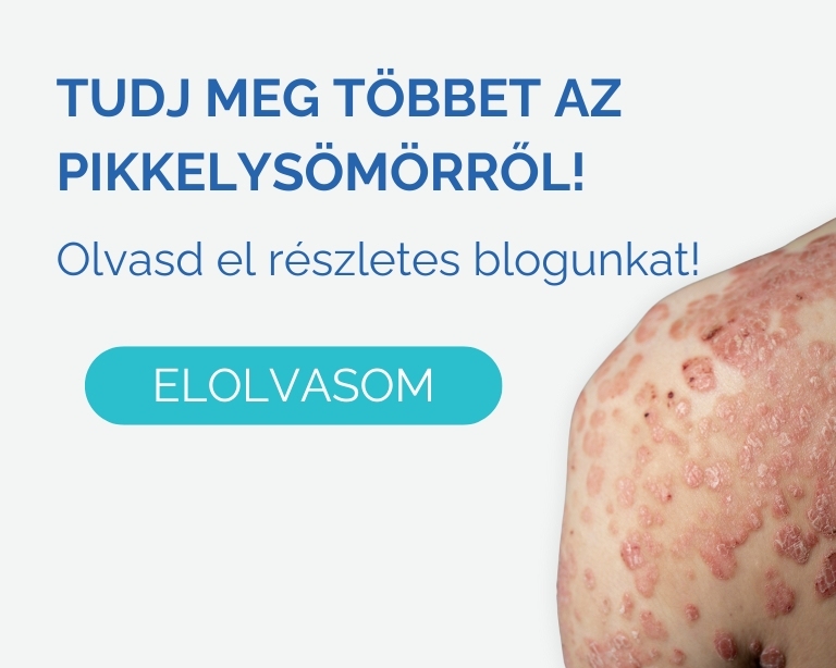 pikkelysomor-kezelese