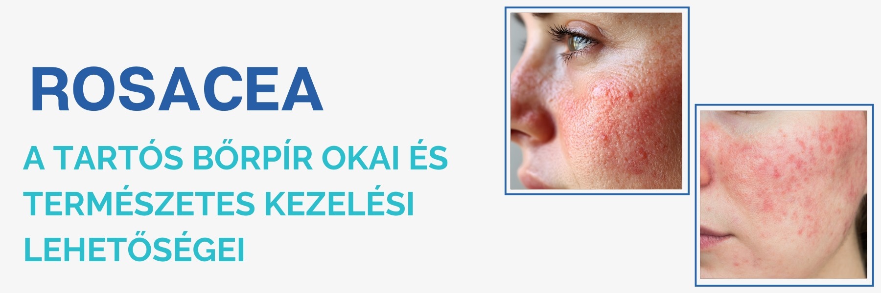 rosacea-kezelese