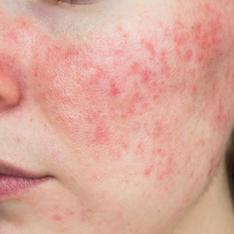 rosacea-kezelese