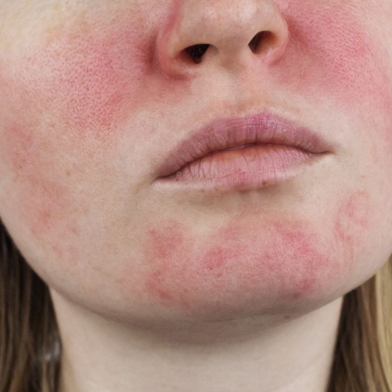 rosacea-kezelese