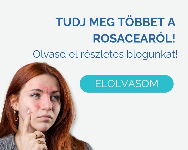 rosacea-kezelese