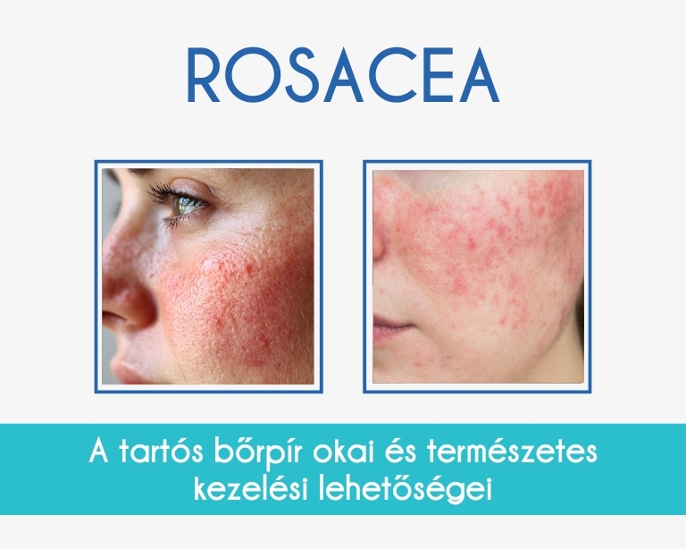 rosacea-kezelese
