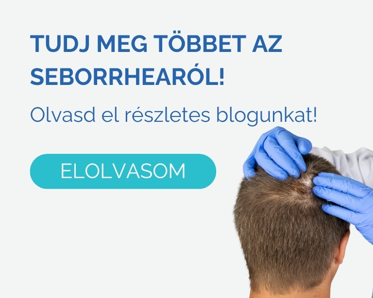 seborrhea-kezelese