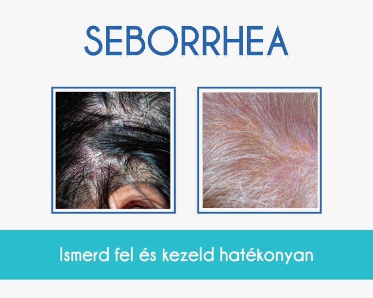 seborrhea